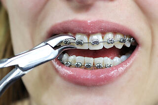 Underbite in Singapore