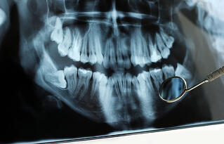 corrective jaw surgery