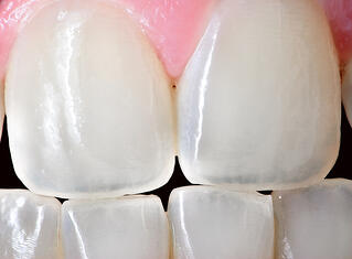 chipped tooth