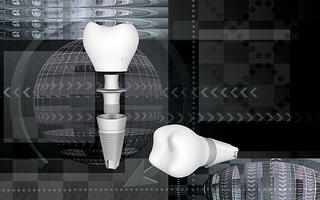 bigstock-Dental-implant-28275257