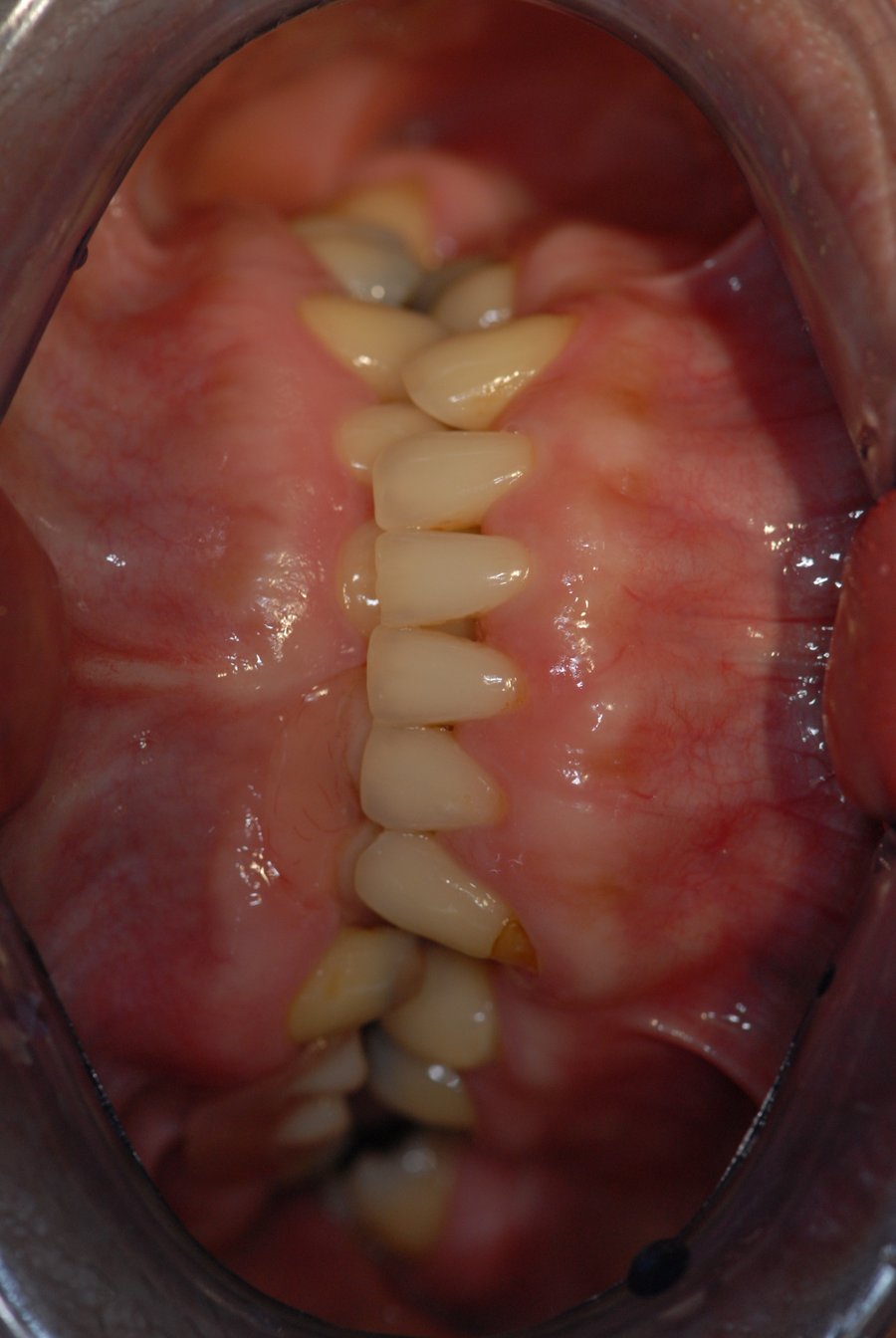 Dental implants in an underbite patient