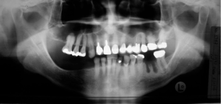 Nerve_transposition_3.png