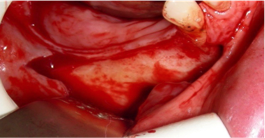 Nerve_transposition_5.png