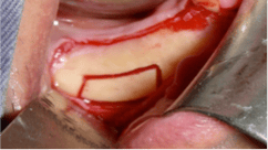 Nerve_transposition_6.png