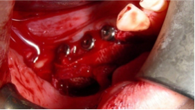 Nerve_transposition_8.png