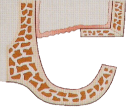 Sinus_bone_graft_1.png