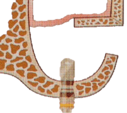 Sinus_bone_graft_2.png