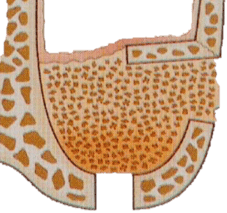 Sinus_bone_graft_3.png