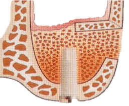 Sinus_bone_graft_4.png