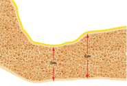 Sinus_bone_graft_5.png