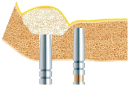 Sinus_bone_graft_6.png