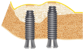 Sinus_bone_graft_7.png