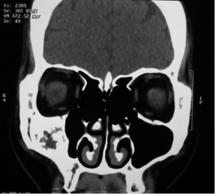 Sinus_bone_graft_8.png