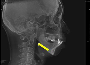 airway