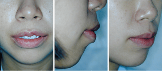 bimaxillary_protrusion_3.png