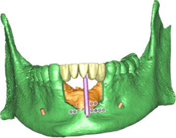 distraction_osteogenesis_3.png
