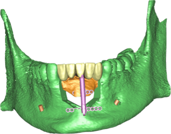 distraction_osteogenesis_4.png