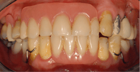 full_mouth_implants_1-1.png