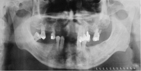 full_mouth_implants_2.png