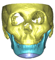 genioplasty_1.png