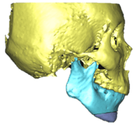 genioplasty_2.png