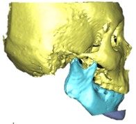 genioplasty_3.png