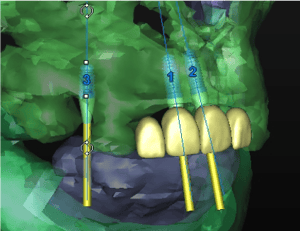 implants