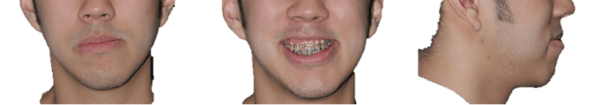 jaw_asymmetry_1.png