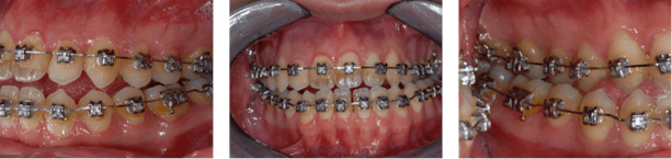 jaw_asymmetry_2.png