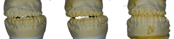 jaw_asymmetry_3.png