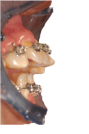 overbite_11.png