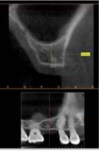 short_implant_2.png
