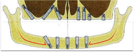 tilted_implant.png