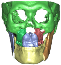 underbite_1.png