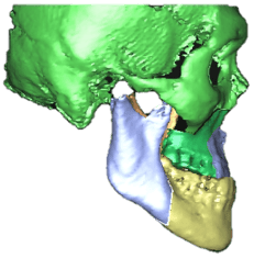 underbite_2.png
