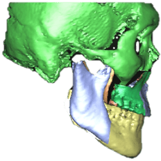 underbite_3.png