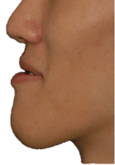underbite_photo.png