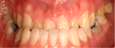 underbite_photo_1.png