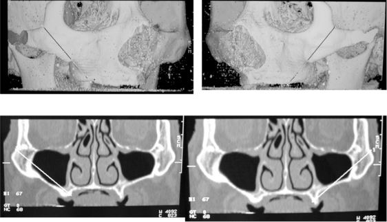zygomatic_implant_1.png