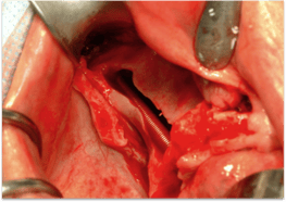 zygomatic_implant_2.png
