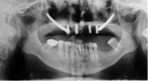 zygomatic_implant_3.png