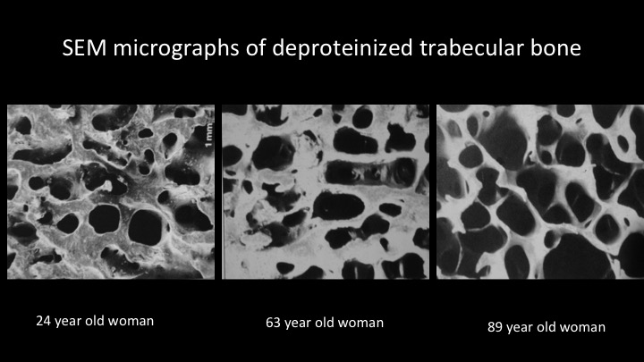 scanning electron micrograph of bone of different densities