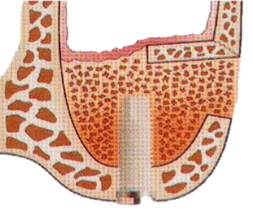 Sinus_bone_graft_4.png