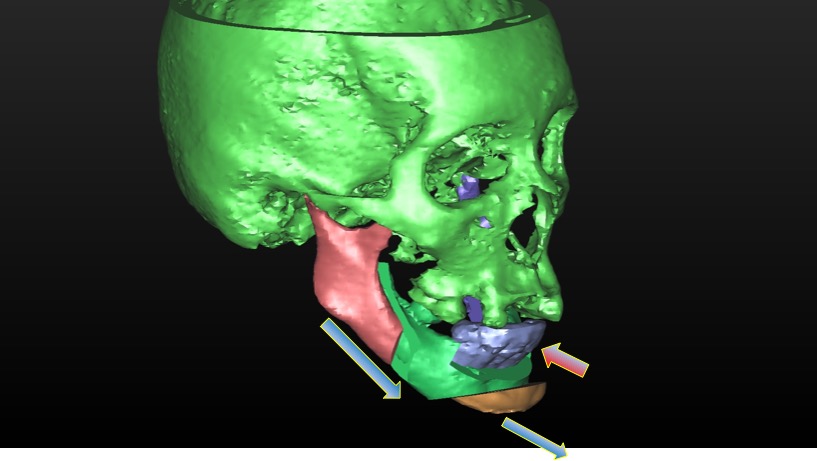 osteotomy