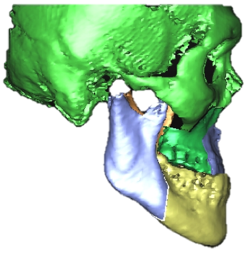 underbite_2